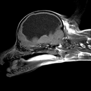 水頭症のMRI画像