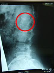腰部のレントゲン画像