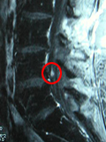 8月12日MRI検査の結果
