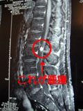 脊髄腫瘍