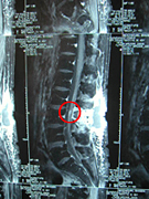 放射線治療後の脊髄のMRI画像