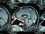 放射線治療後の脳のMRI画像